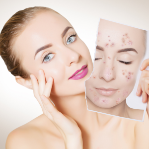 Oily & Acne-prone skin